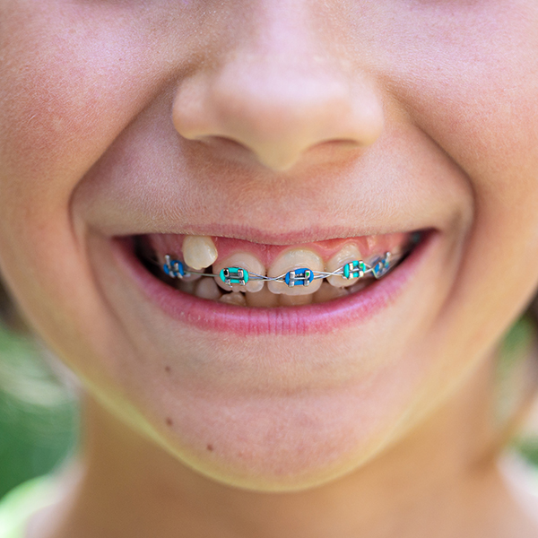 Braces Who Why When