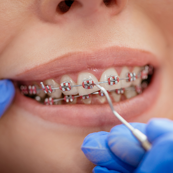 orthodontics chapel hill