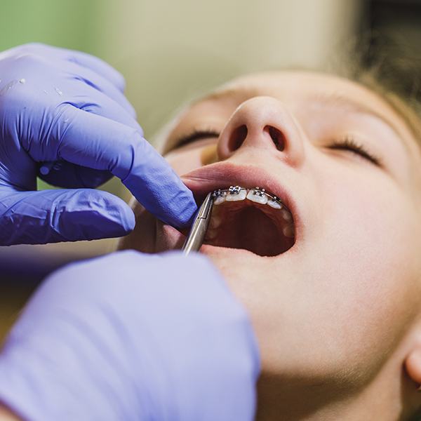 orthodontist chapel hill