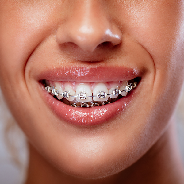orthodontist chapel hill