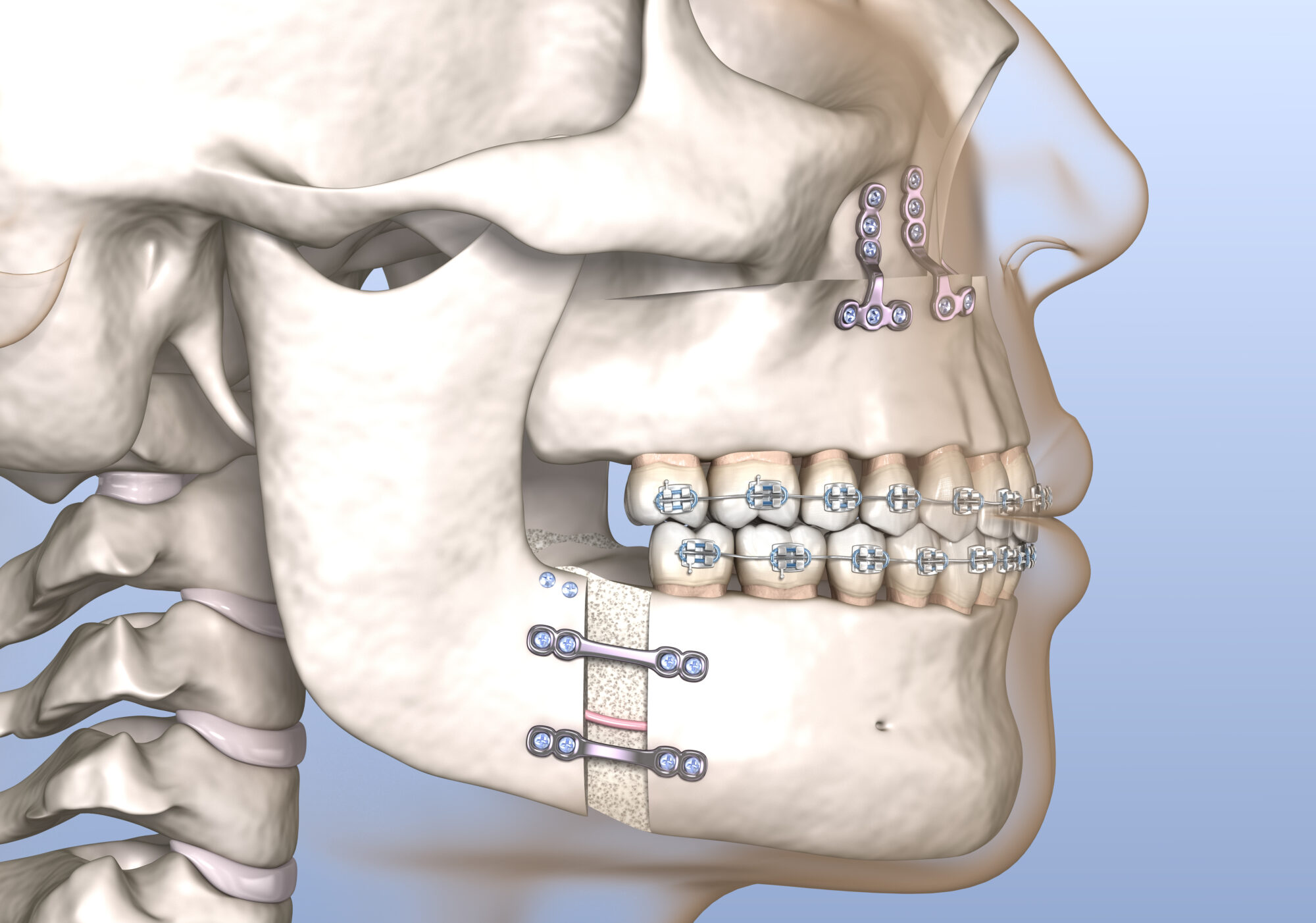 The Benefits of Orthognathic Surgery as Part of Orthodontic Care